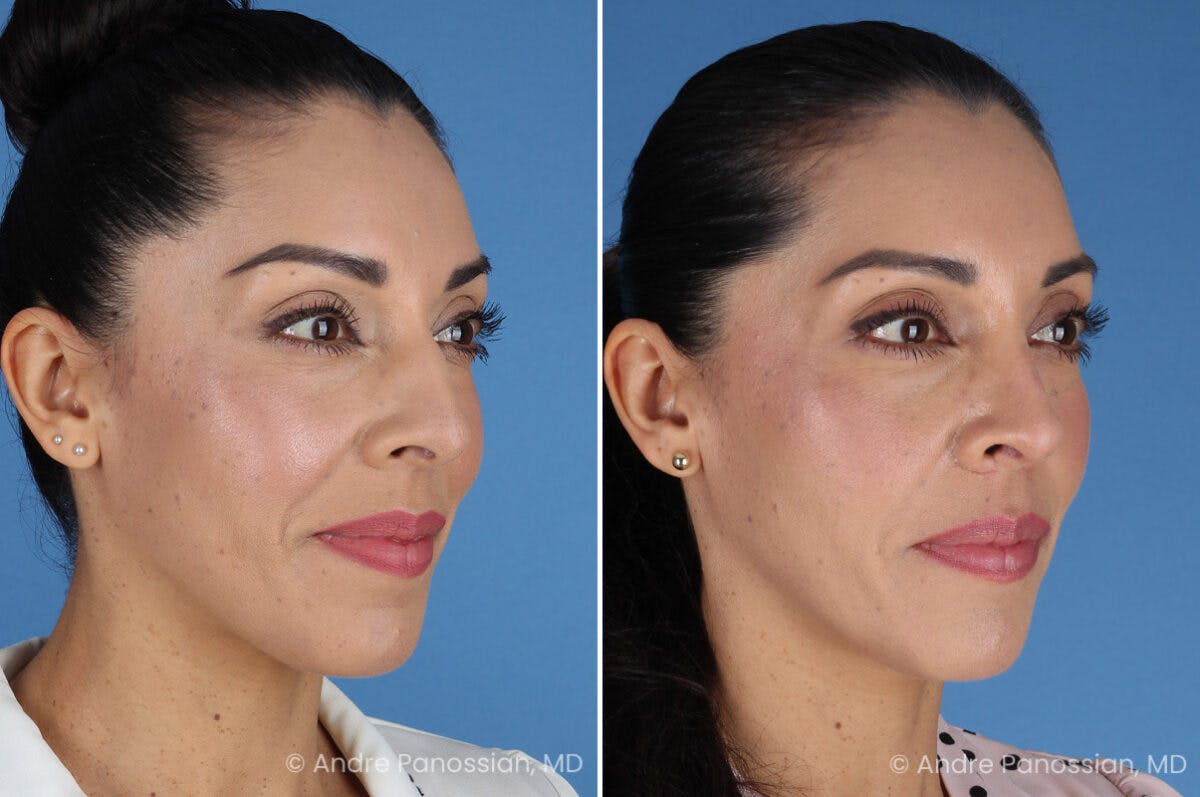 Rhinoplasty Before & After Gallery - Patient 364218 - Image 3