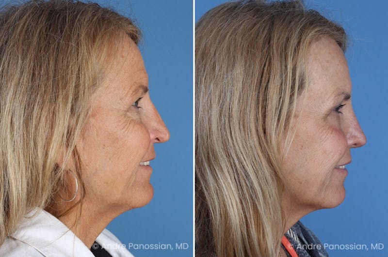 Revision Rhinoplasty Before & After Gallery - Patient 283123 - Image 1