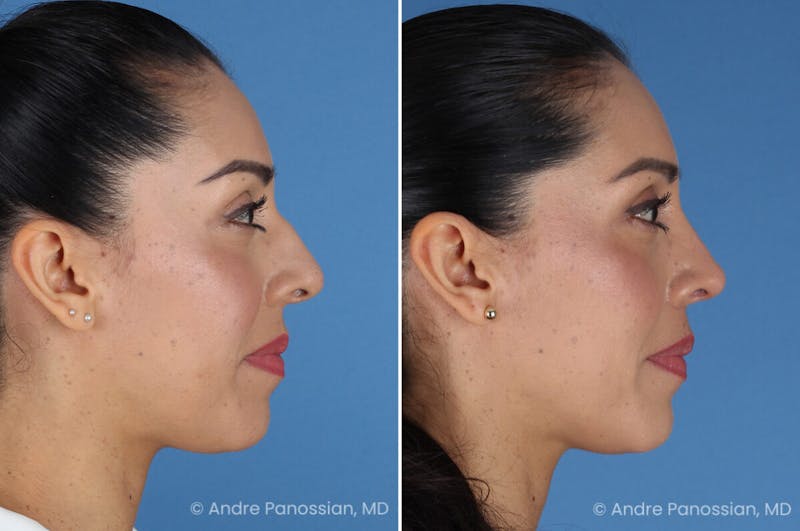 Rhinoplasty Before & After Gallery - Patient 364218 - Image 1