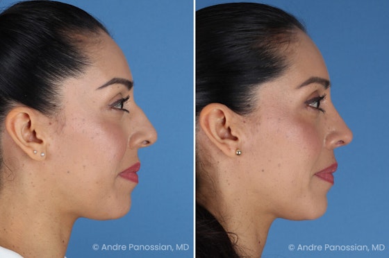 Rhinoplasty before and after — actual patient of Andre Panossian, MD