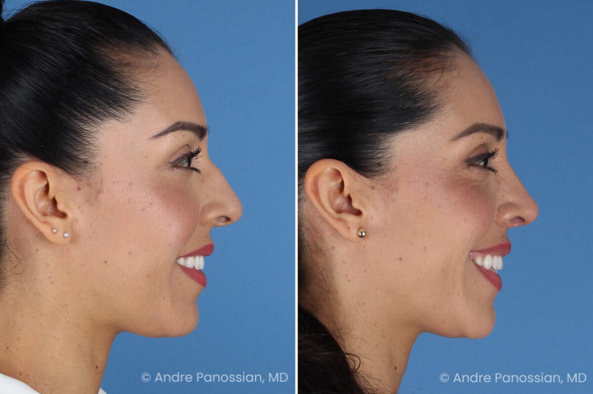 Rhinoplasty Before & After Gallery - Patient 364218 - Image 4