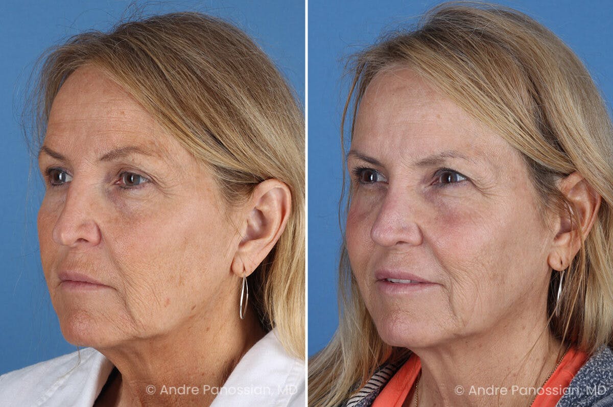 Revision Rhinoplasty Before & After Gallery - Patient 283123 - Image 5