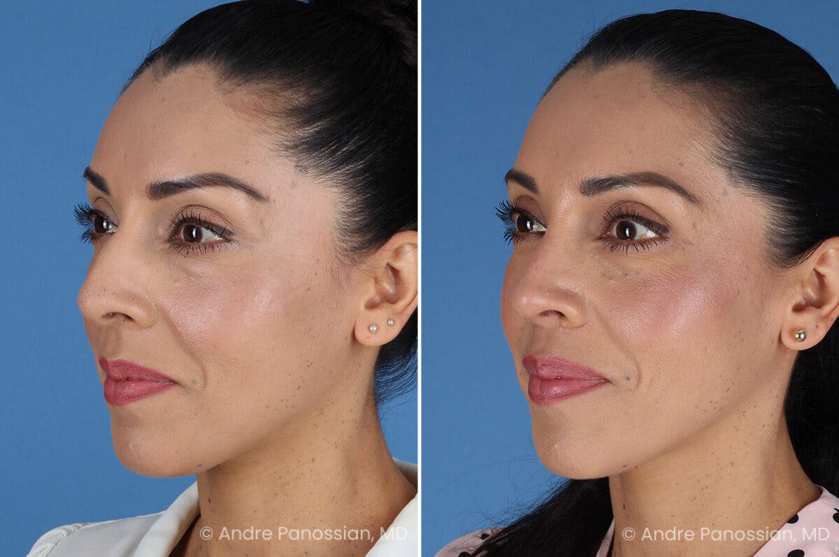 Rhinoplasty Before & After Gallery - Patient 364218 - Image 5