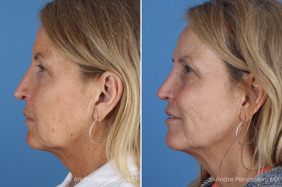 Revision Rhinoplasty Before & After Gallery - Patient 283123 - Image 6