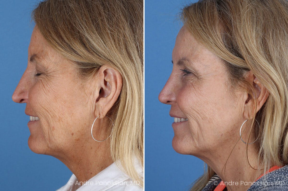 Revision Rhinoplasty Before & After Gallery - Patient 283123 - Image 7