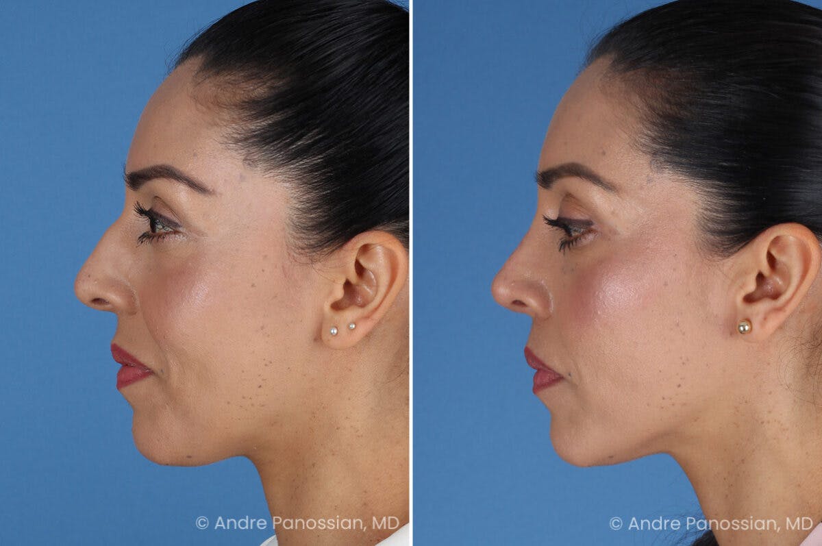 Rhinoplasty Before & After Gallery - Patient 364218 - Image 6