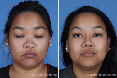 Cleft Lip Rhinoplasty Before & After Photos | Andre Panossian, M.D.