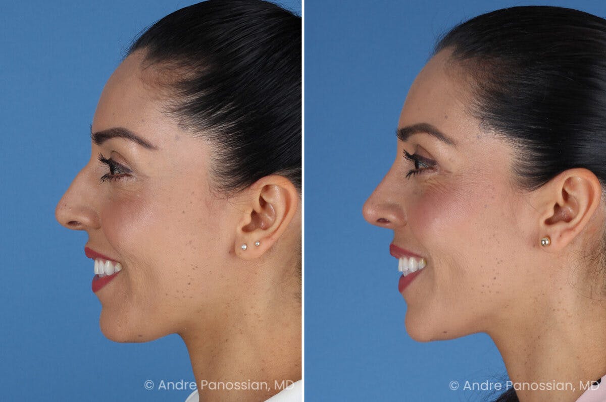 Rhinoplasty Before & After Gallery - Patient 364218 - Image 7