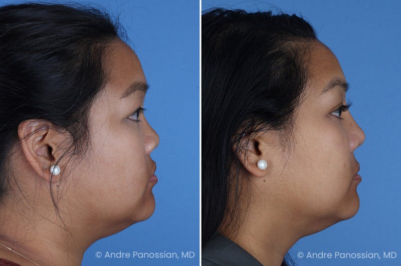 Cleft Lip Rhinoplasty Before & After Gallery - Patient 215653 - Image 1