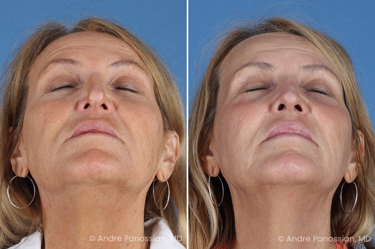 Revision Rhinoplasty Before & After Gallery - Patient 283123 - Image 8