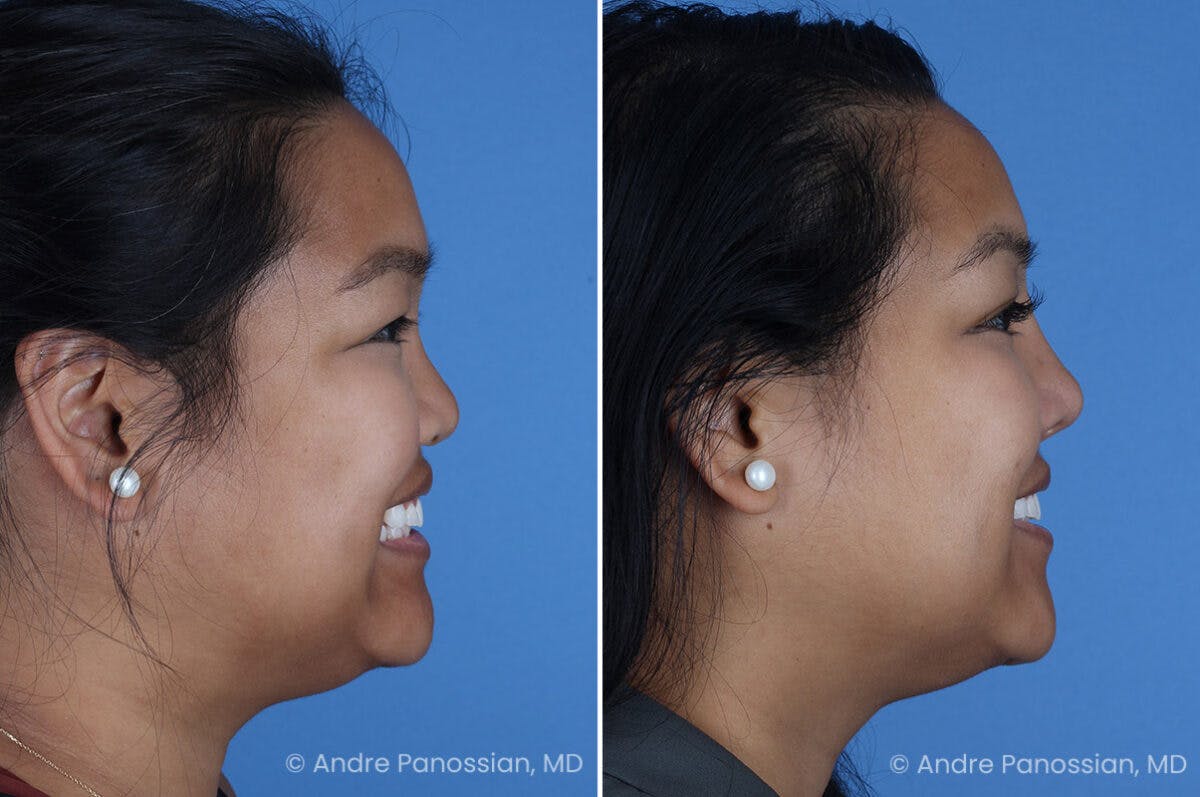 Cleft Lip Rhinoplasty Before & After Gallery - Patient 215653 - Image 3