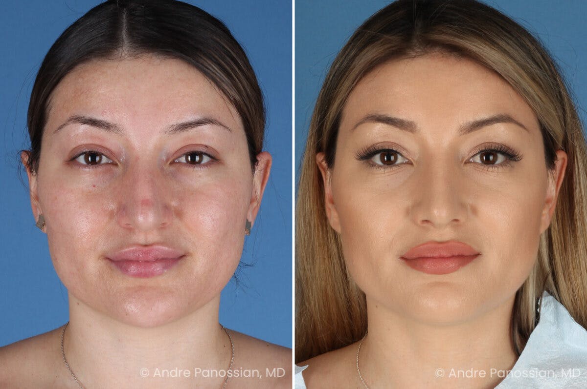Rhinoplasty Before & After Gallery - Patient 175540 - Image 2