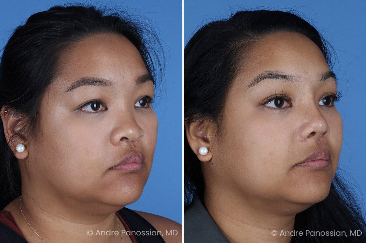 Cleft Lip Rhinoplasty Before & After Gallery - Patient 215653 - Image 4