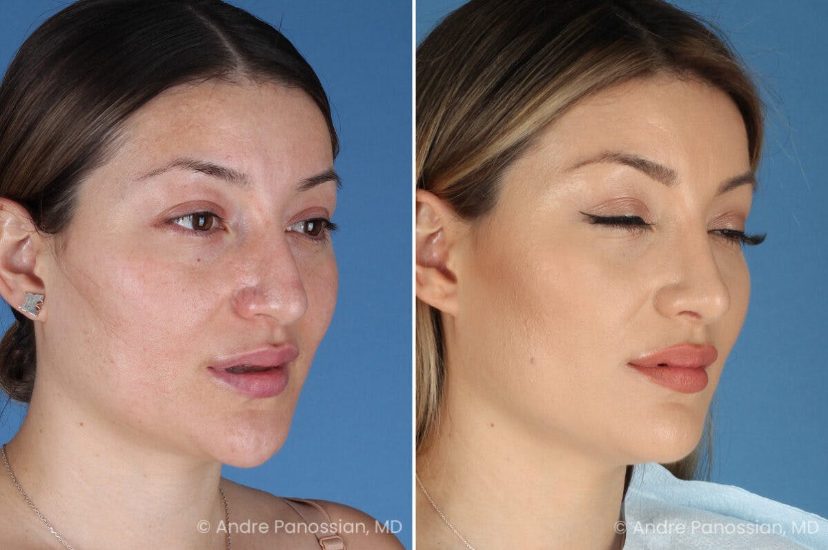 Rhinoplasty Before & After Gallery - Patient 175540 - Image 3