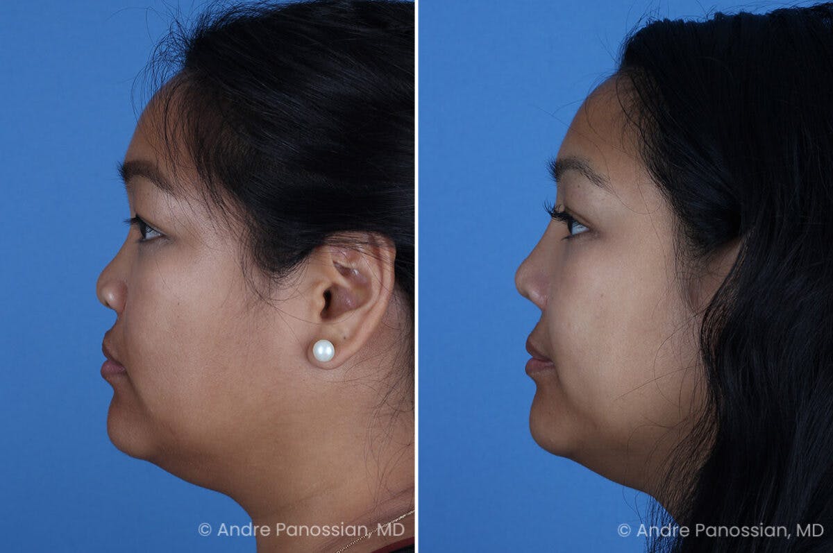 Cleft Lip Rhinoplasty Before & After Gallery - Patient 215653 - Image 5