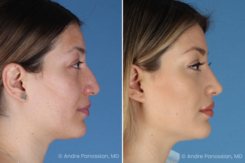 Rhinoplasty Before & After Gallery - Patient 175540 - Image 1