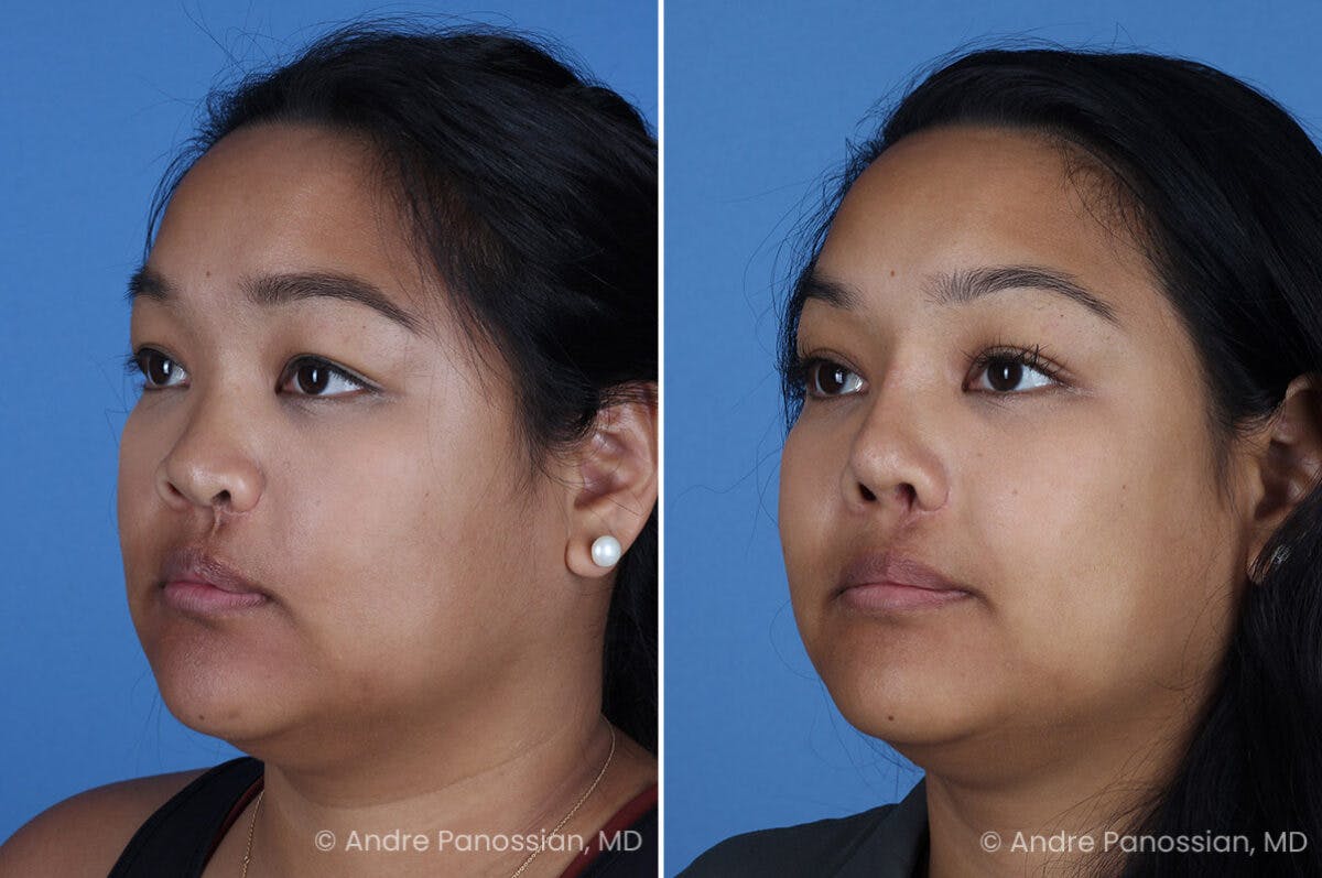 Cleft Lip Rhinoplasty Before & After Gallery - Patient 215653 - Image 6