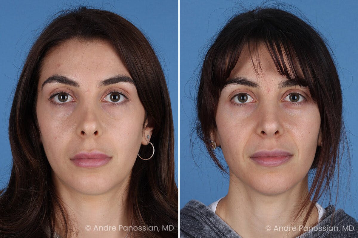 Revision Rhinoplasty Before & After Gallery - Patient 174934 - Image 2