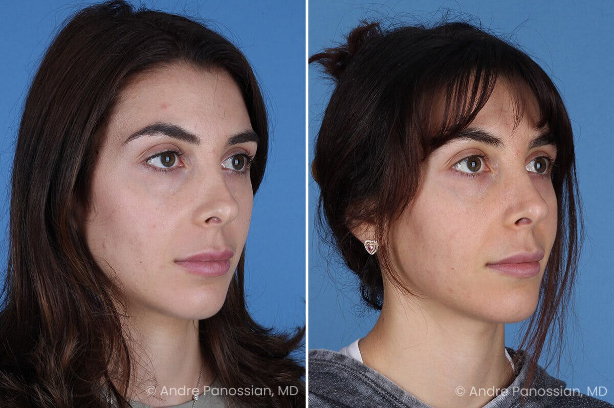 Revision Rhinoplasty Before & After Gallery - Patient 174934 - Image 3