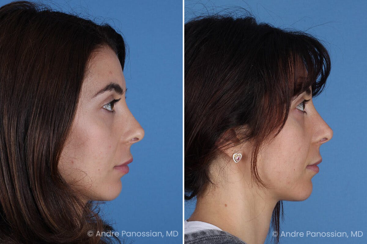 Revision Rhinoplasty Before & After Gallery - Patient 174934 - Image 4