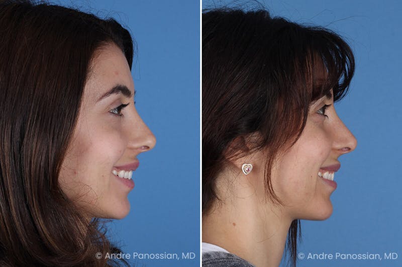 Revision Rhinoplasty Before & After Gallery - Patient 174934 - Image 1