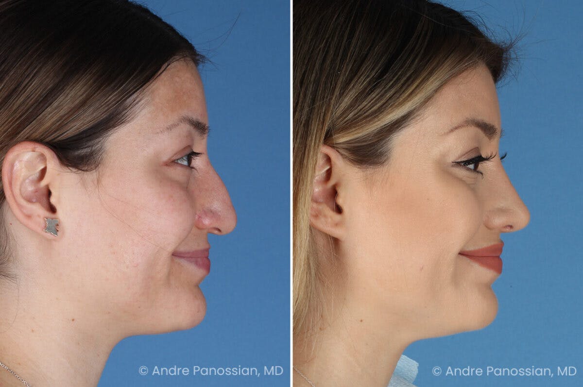 Rhinoplasty Before & After Gallery - Patient 175540 - Image 4