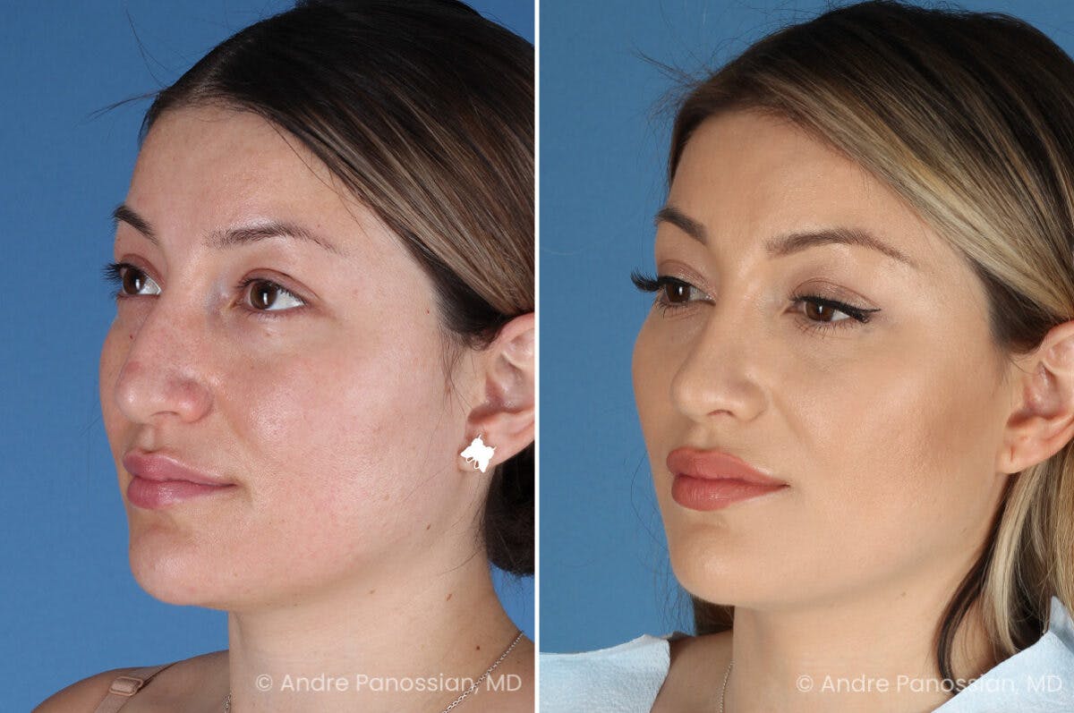 Rhinoplasty Before & After Gallery - Patient 175540 - Image 5