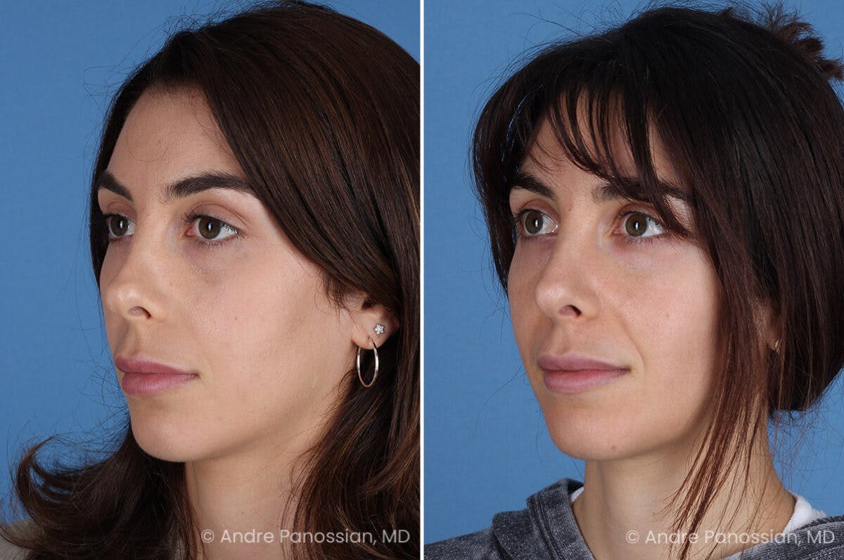 Revision Rhinoplasty Before & After Gallery - Patient 174934 - Image 5