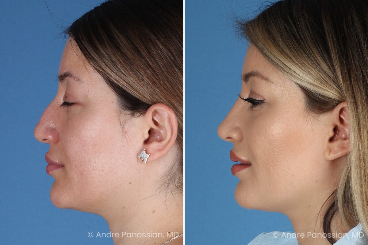 Rhinoplasty Before & After Gallery - Patient 175540 - Image 6