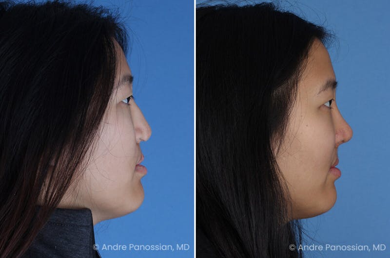 Cleft Lip Rhinoplasty Before & After Gallery - Patient 240675 - Image 1