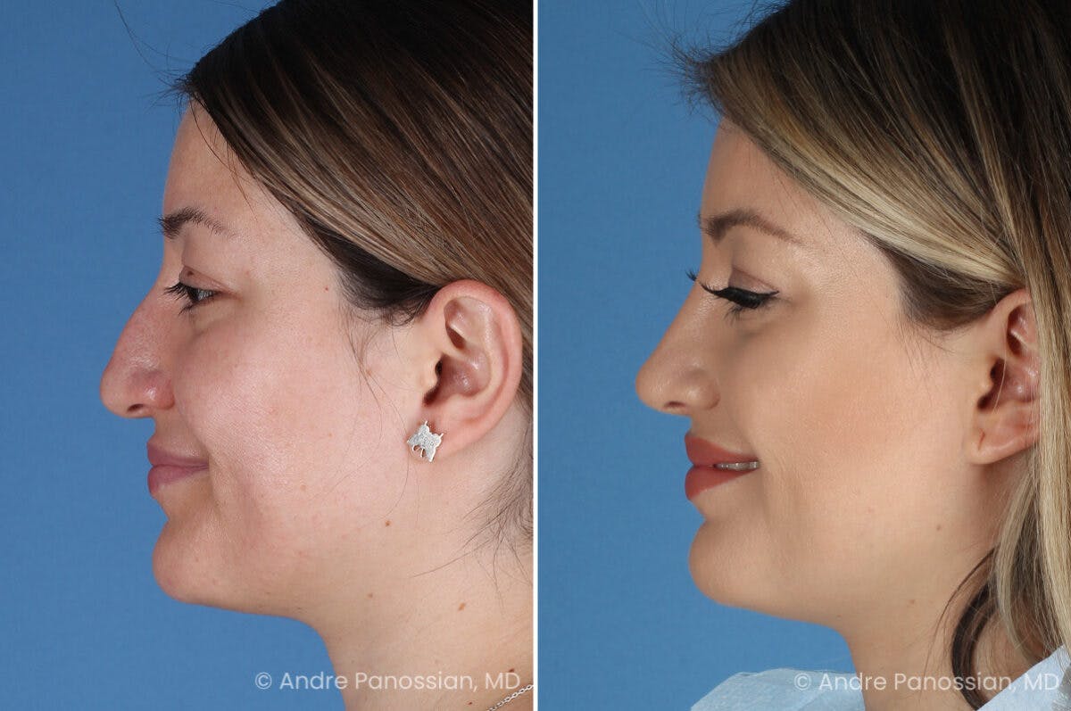 Rhinoplasty Before & After Gallery - Patient 175540 - Image 7