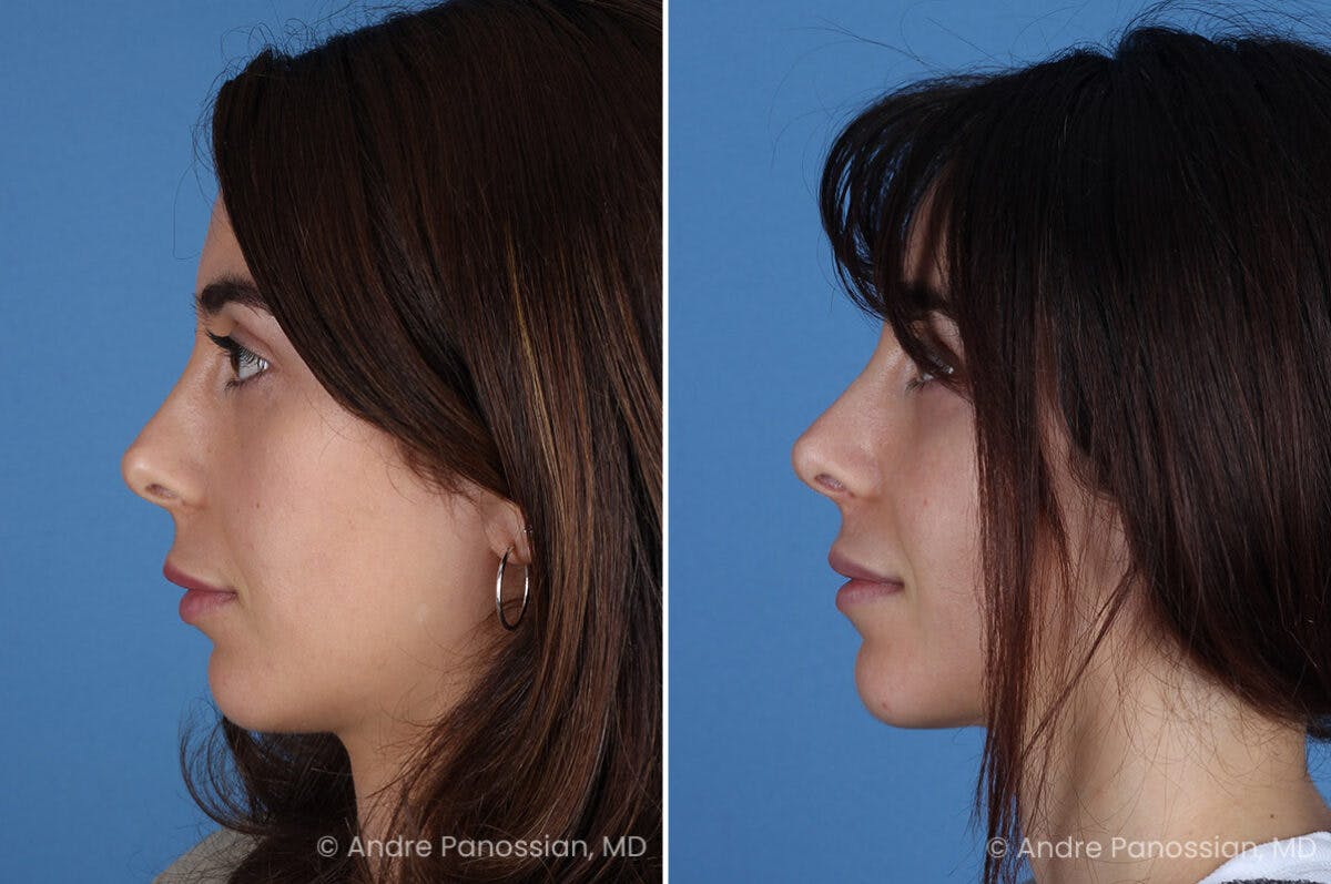 Revision Rhinoplasty Before & After Gallery - Patient 174934 - Image 6