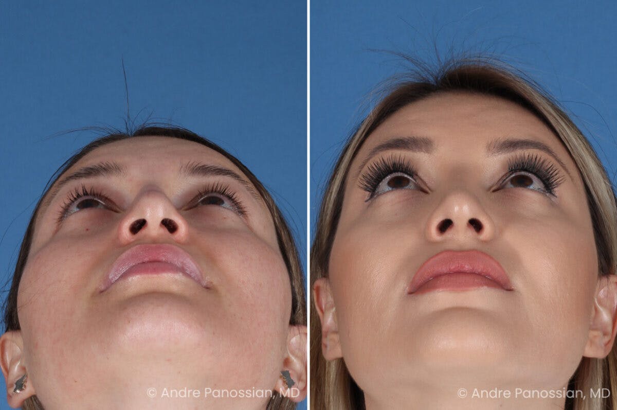 Rhinoplasty Before & After Gallery - Patient 175540 - Image 8