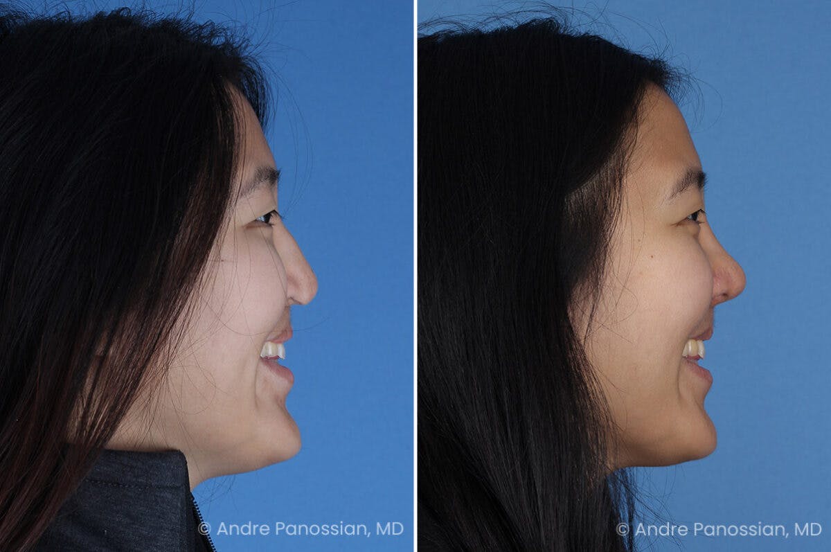Cleft Lip Rhinoplasty Before & After Gallery - Patient 240675 - Image 3