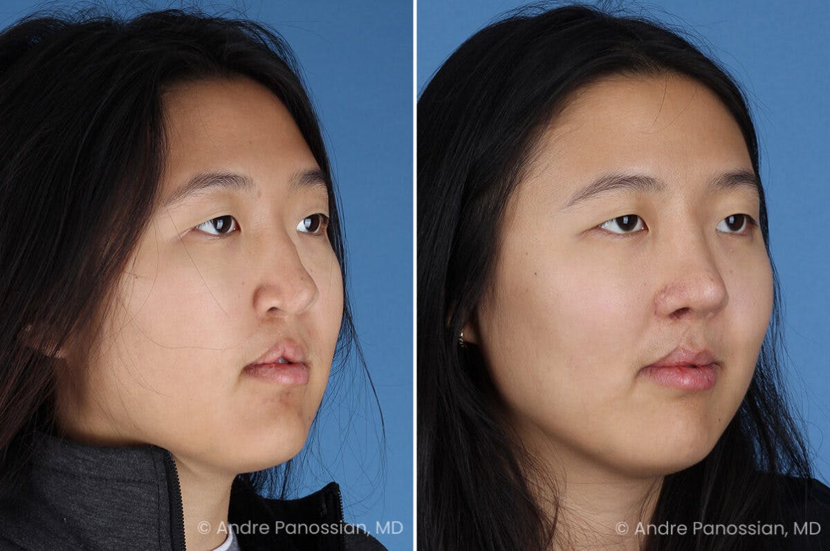 Cleft Lip Rhinoplasty Before & After Gallery - Patient 240675 - Image 4