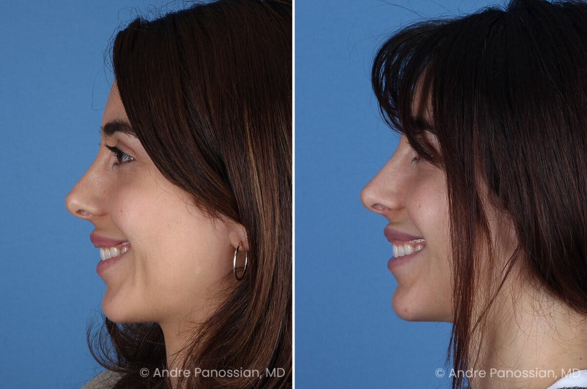 Revision Rhinoplasty Before & After Gallery - Patient 174934 - Image 7