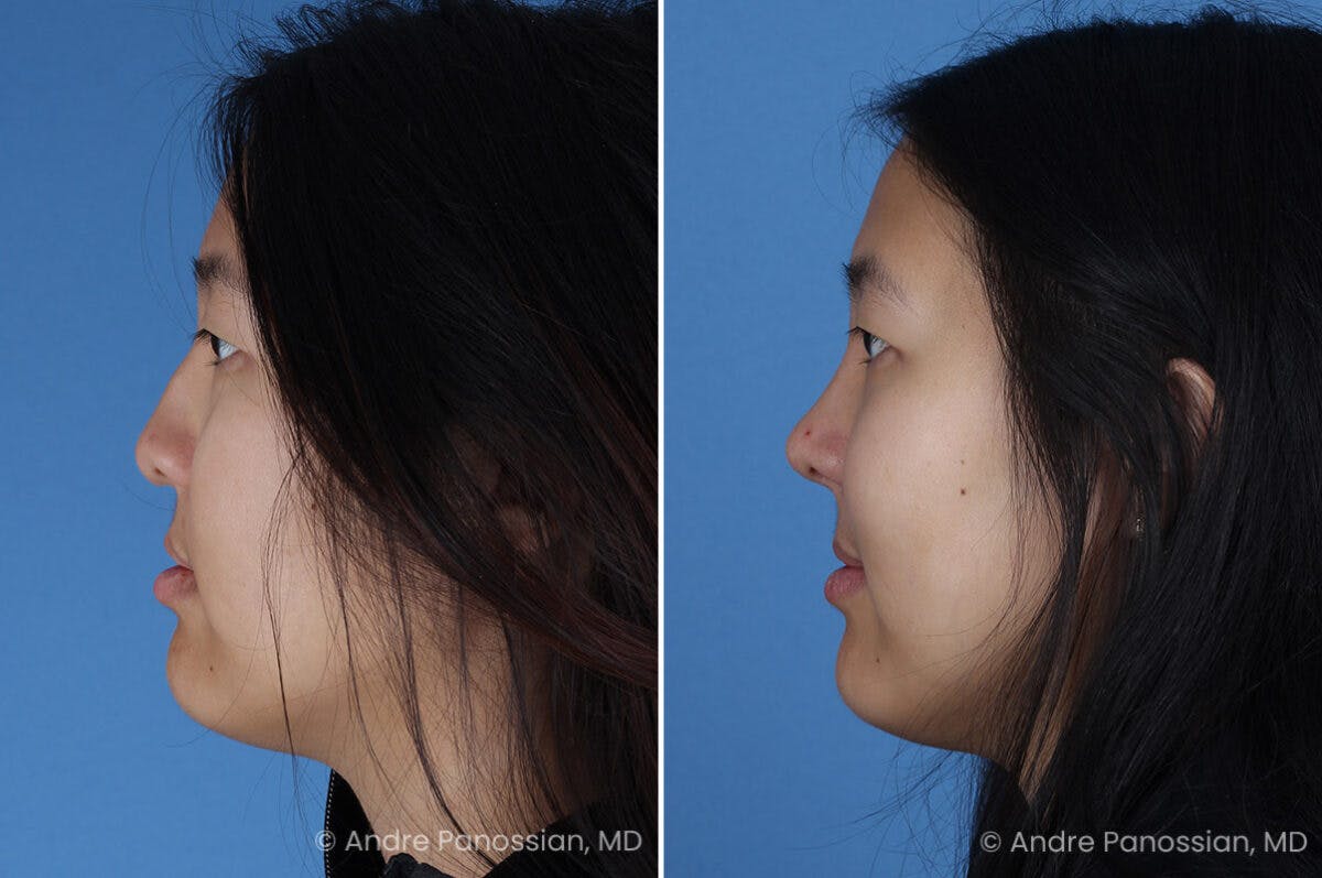 Cleft Lip Rhinoplasty Before & After Gallery - Patient 240675 - Image 5