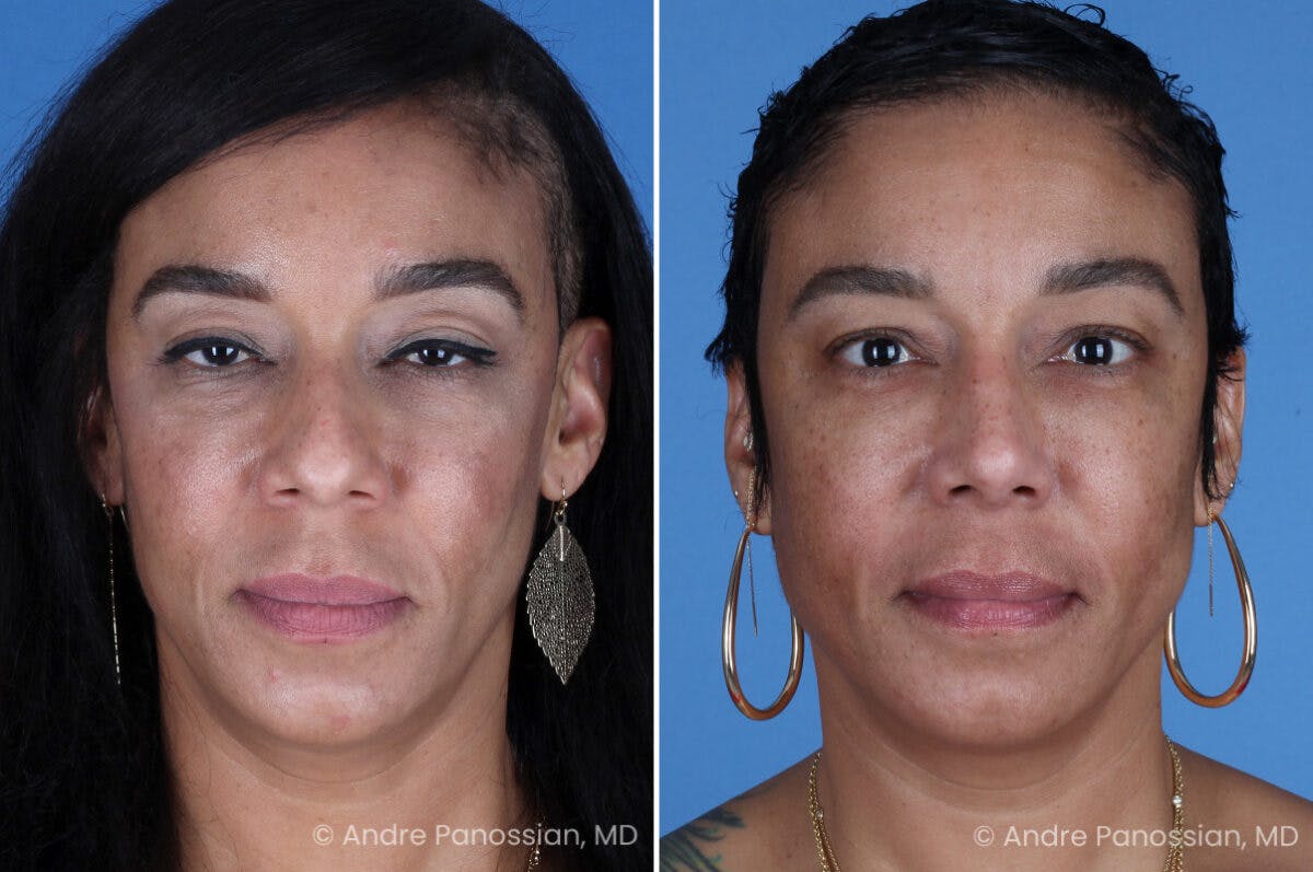 Rhinoplasty Before & After Gallery - Patient 319593 - Image 2