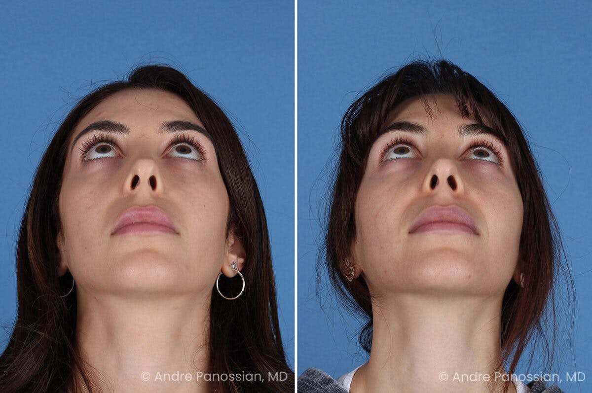 Revision Rhinoplasty Before & After Gallery - Patient 174934 - Image 8