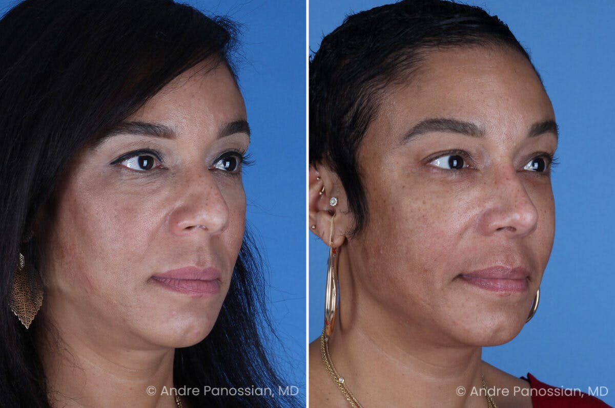 Rhinoplasty Before & After Gallery - Patient 319593 - Image 3