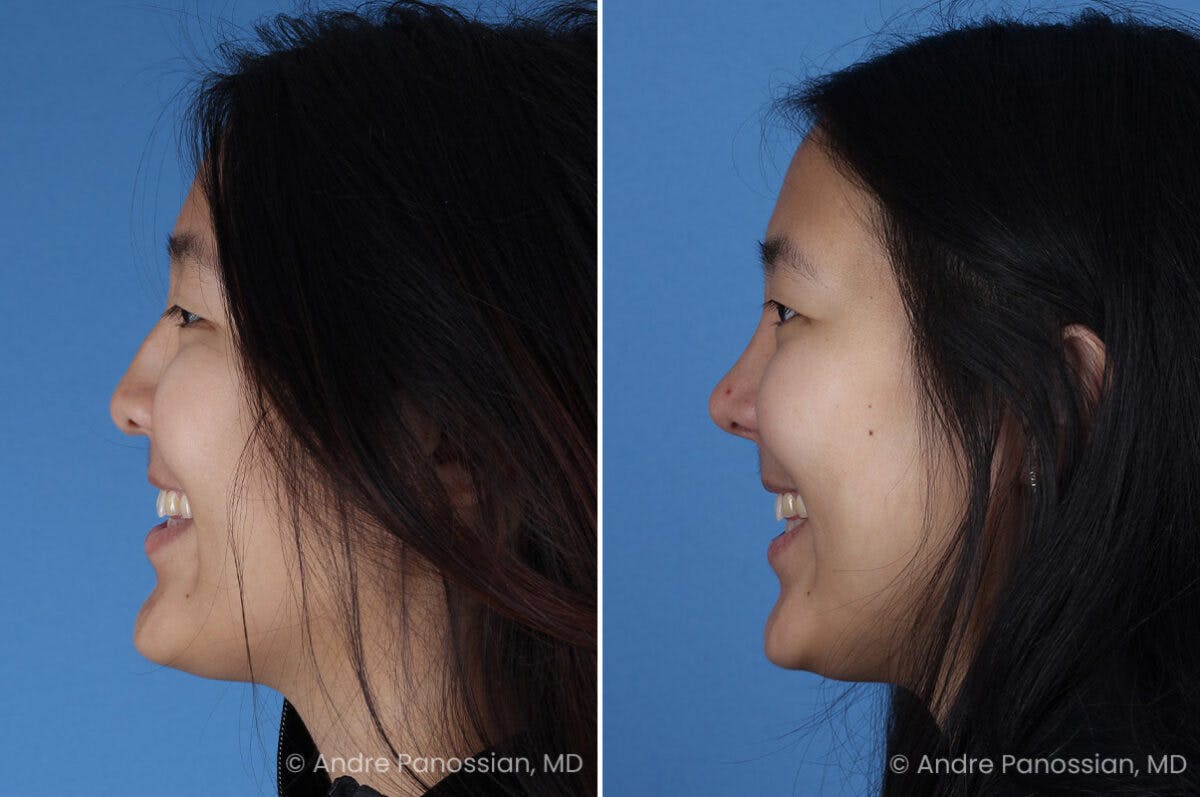 Cleft Lip Rhinoplasty Before & After Gallery - Patient 240675 - Image 6