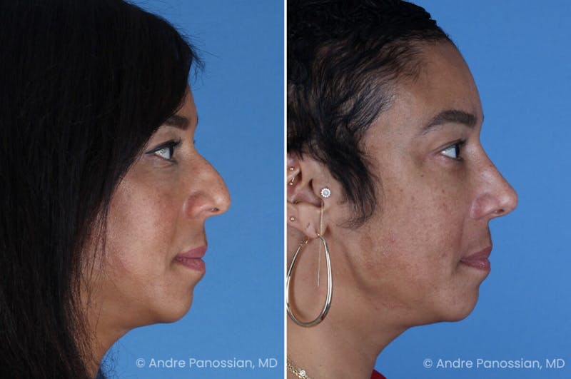 Rhinoplasty Before & After Gallery - Patient 319593 - Image 1