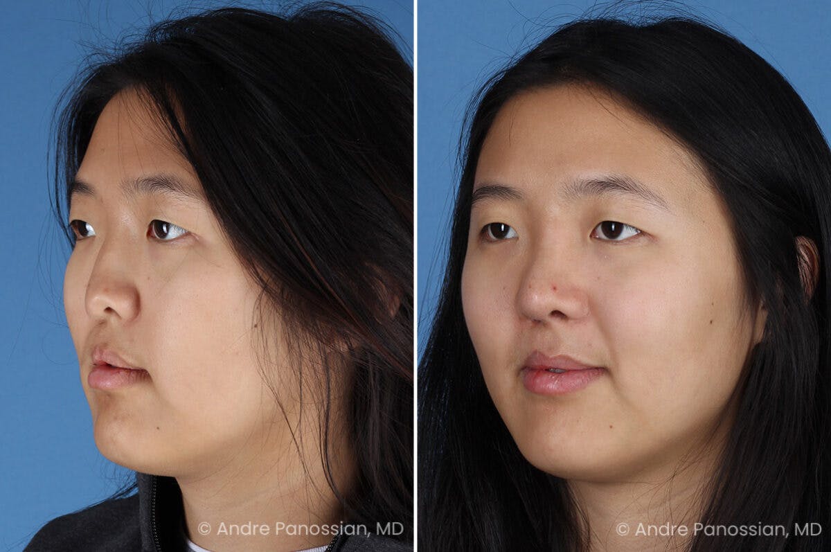 Cleft Lip Rhinoplasty Before & After Gallery - Patient 240675 - Image 7