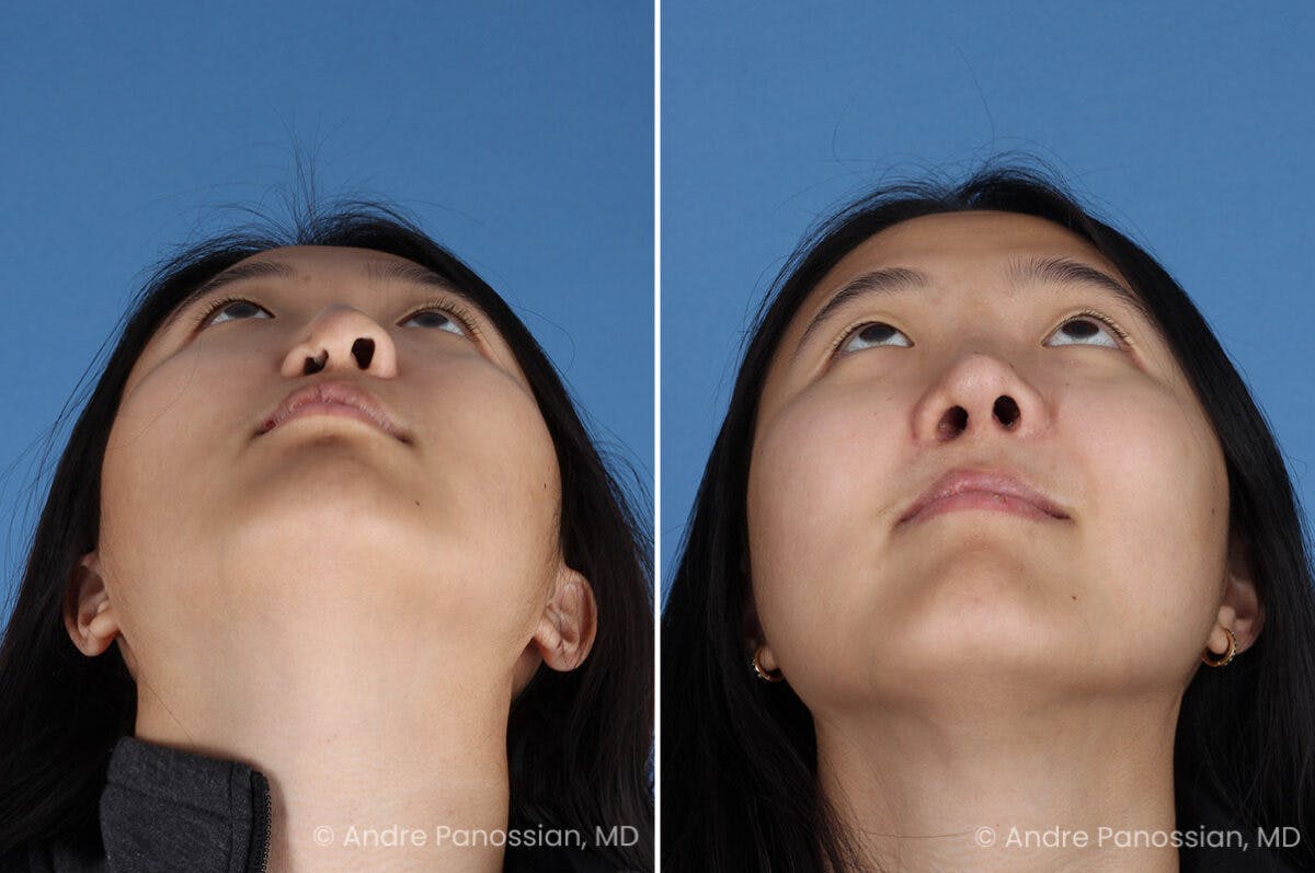 Cleft Lip Rhinoplasty Before & After Gallery - Patient 240675 - Image 8