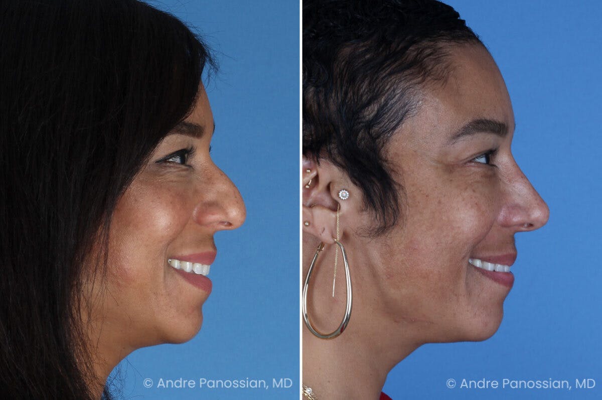 Rhinoplasty Before & After Gallery - Patient 319593 - Image 4