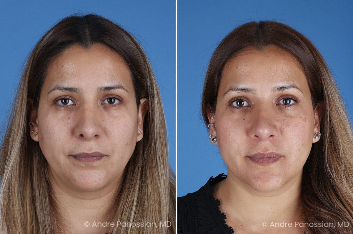 Revision Rhinoplasty Before & After Gallery - Patient 185311 - Image 2