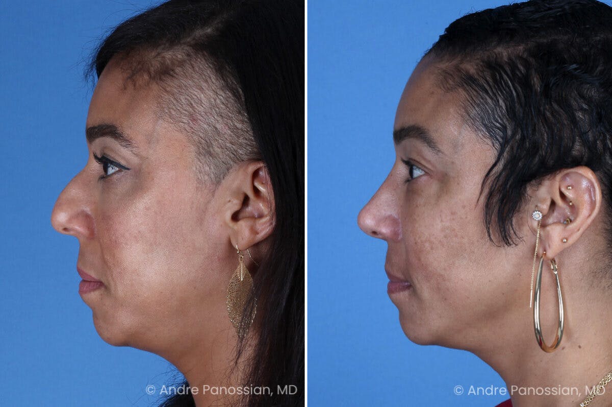 Rhinoplasty Before & After Gallery - Patient 319593 - Image 6