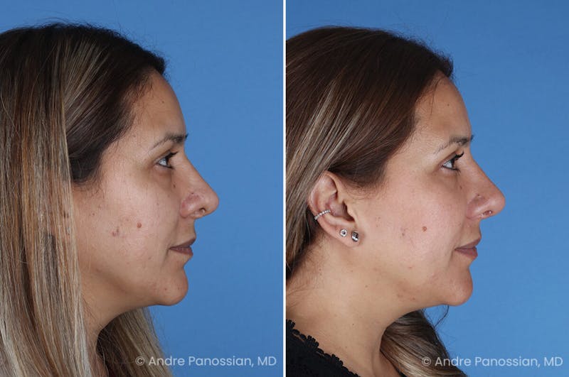 Revision Rhinoplasty Before & After Gallery - Patient 185311 - Image 1