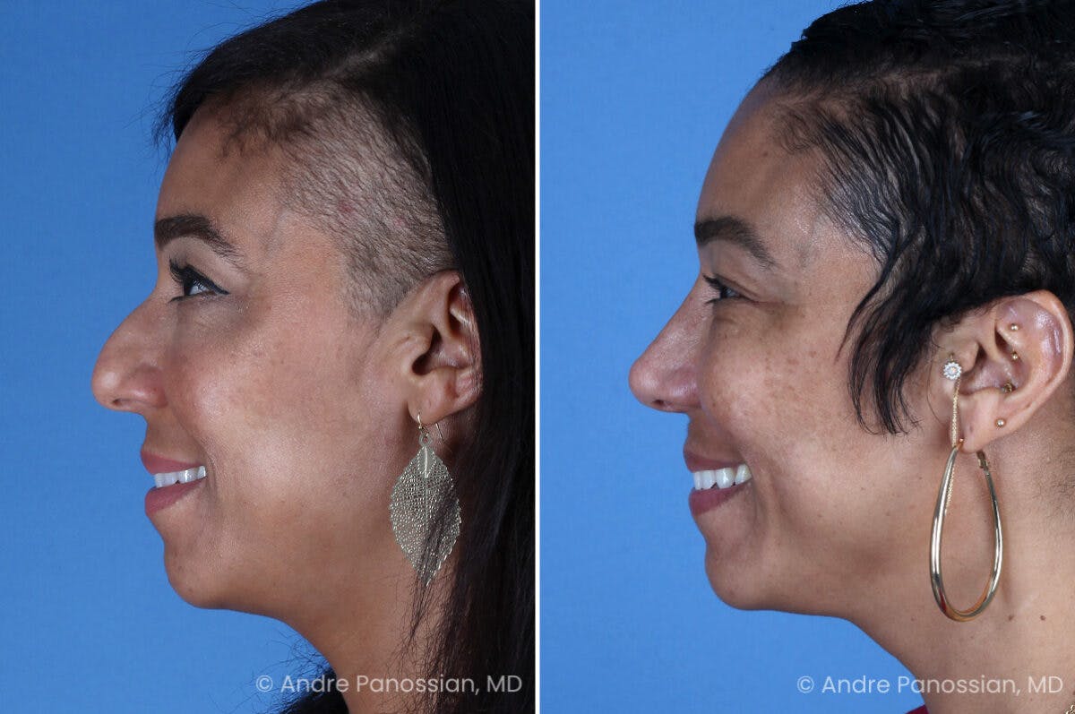 Rhinoplasty Before & After Gallery - Patient 319593 - Image 7
