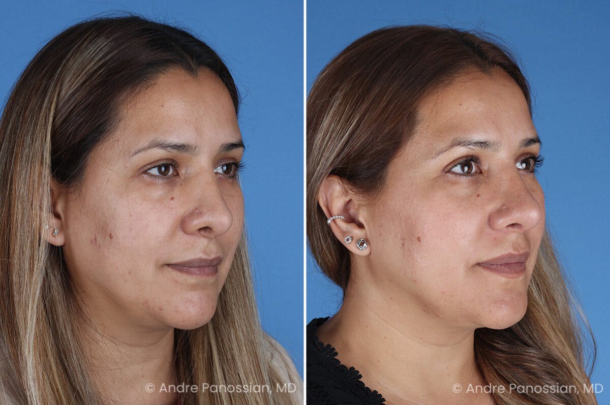 Revision Rhinoplasty Before & After Gallery - Patient 185311 - Image 3
